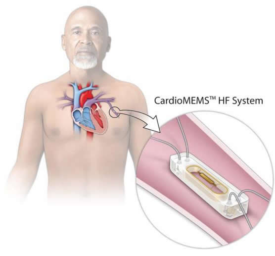 оCardioMEMS˥סԺʽ44%