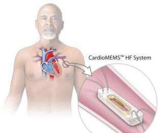оCardioMEMS˥סԺʽ44%